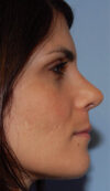 Rhinoplasty case #3809