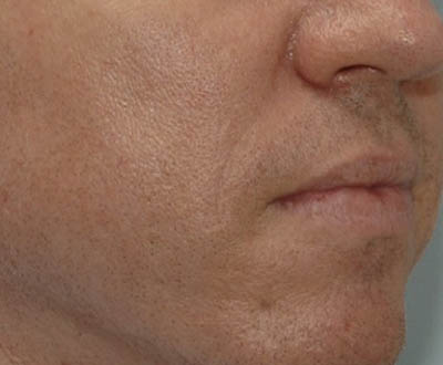 Fillers case #4342