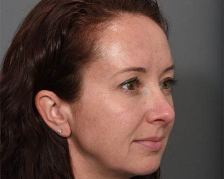 Fillers case #4345