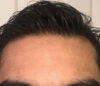 Hair Restoration case #3665