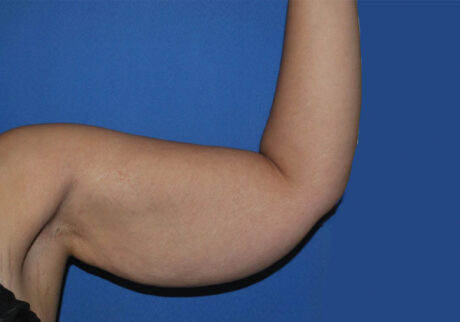 Arm Lift case #3689