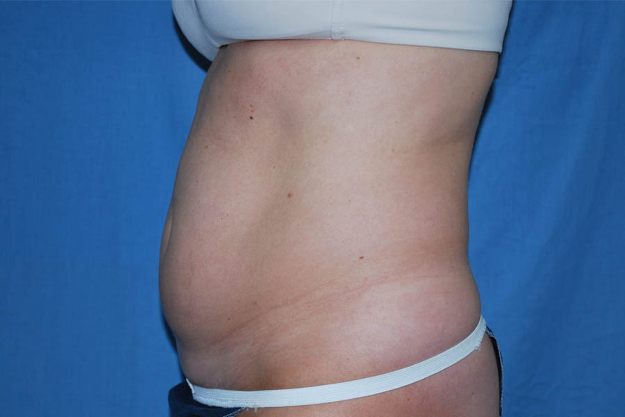 Liposuction case #4503