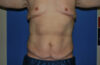 Male Breast Reduction case #4846
