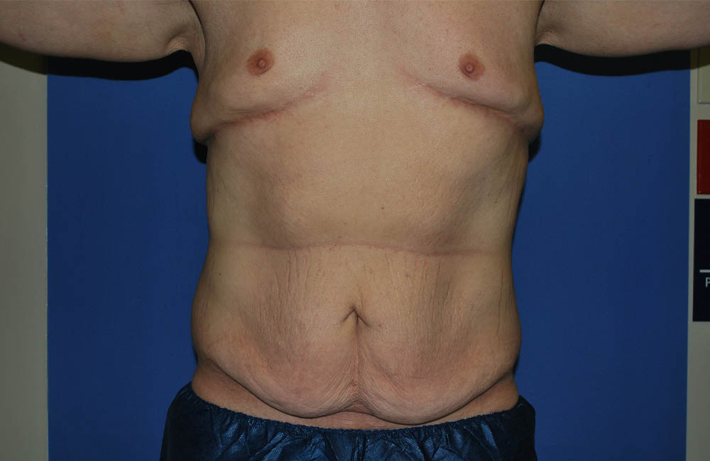 Male Breast Reduction case #4846