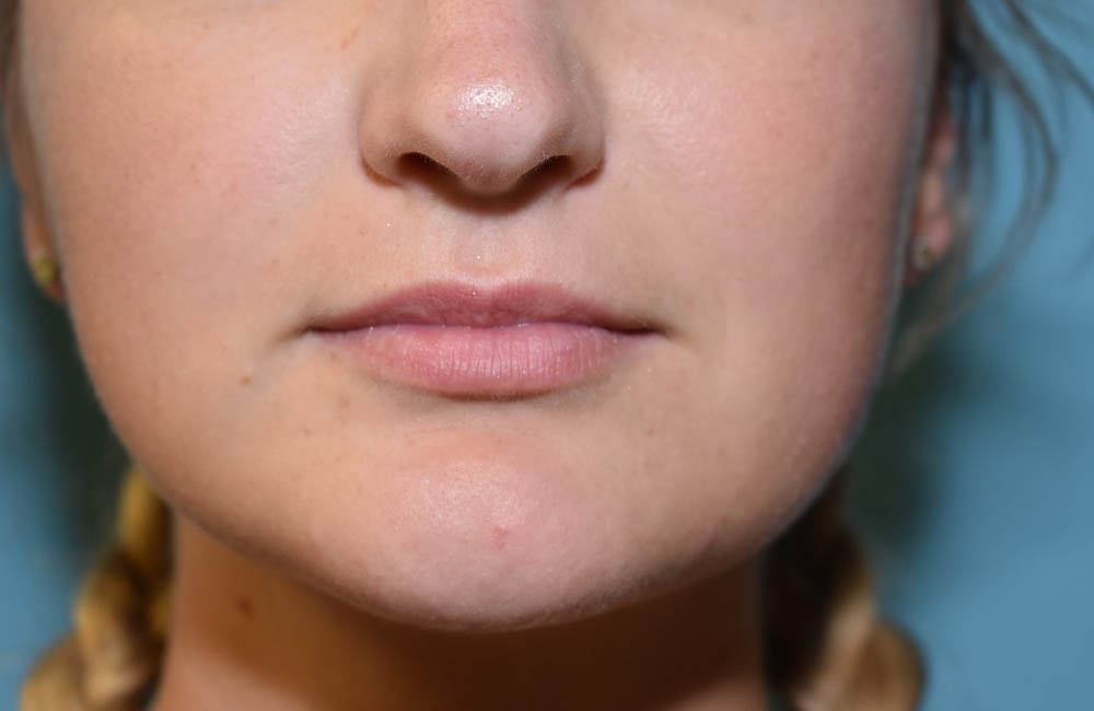 Fillers case #4348