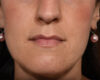 Fillers case #4351