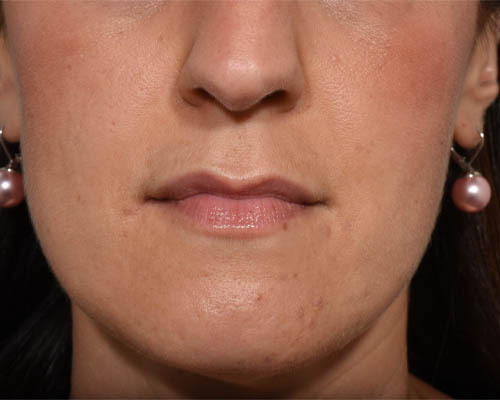 Fillers case #4351