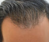 Hair Restoration case #3665