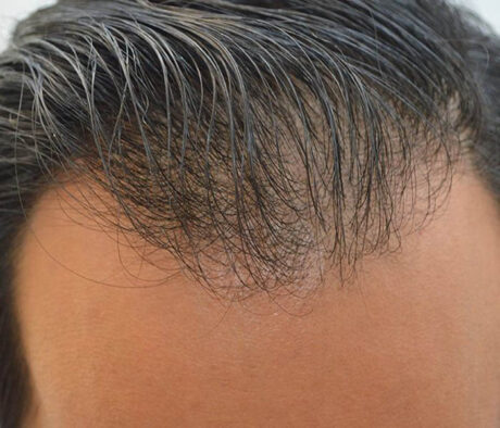 Hair Restoration case #3665