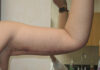 Arm Lift case #3689