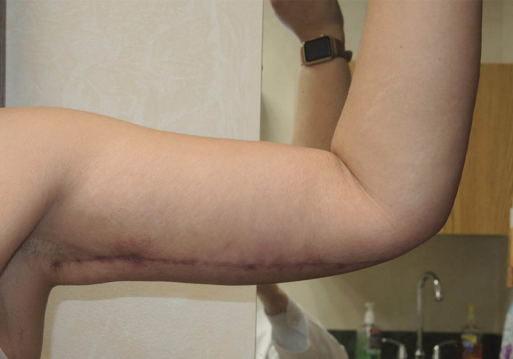 Arm Lift case #3689