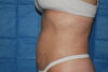 Liposuction case #4503