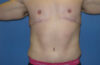 Male Breast Reduction case #4846