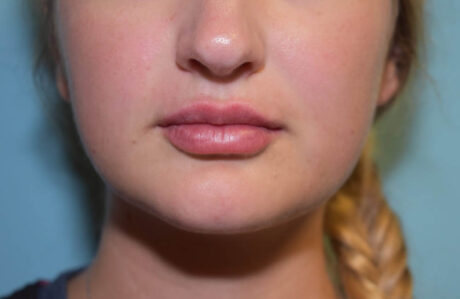 Fillers case #4348