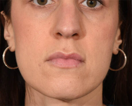 Fillers case #4351