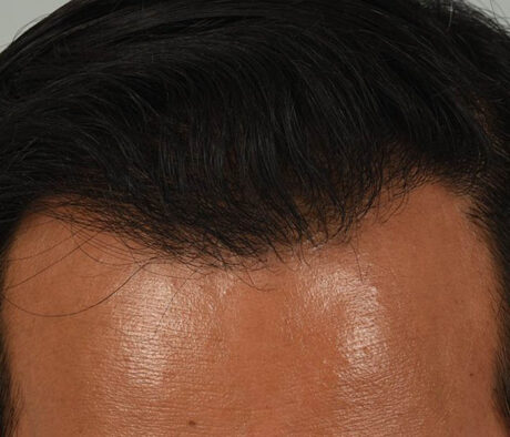 Hair Restoration case #3665