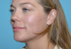 Thermage case #3576