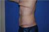 Male Breast Reduction case #4846