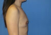 Breast Augmentation case #3879