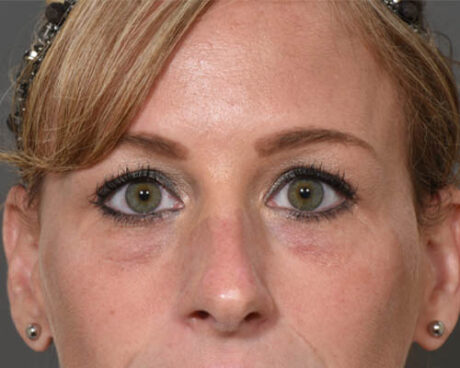 Fillers case #4354