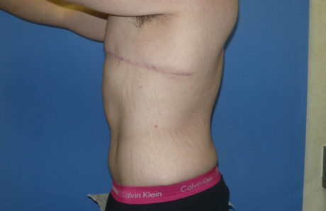 Male Breast Reduction case #4846