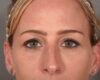 Fillers case #4354