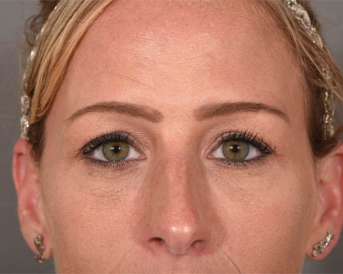 Fillers case #4354