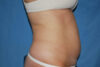 Liposuction case #4503