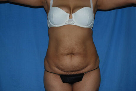 Mommy Makeover case #5638