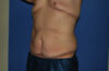 Male Breast Reduction case #4846
