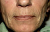 Fillers case #4366