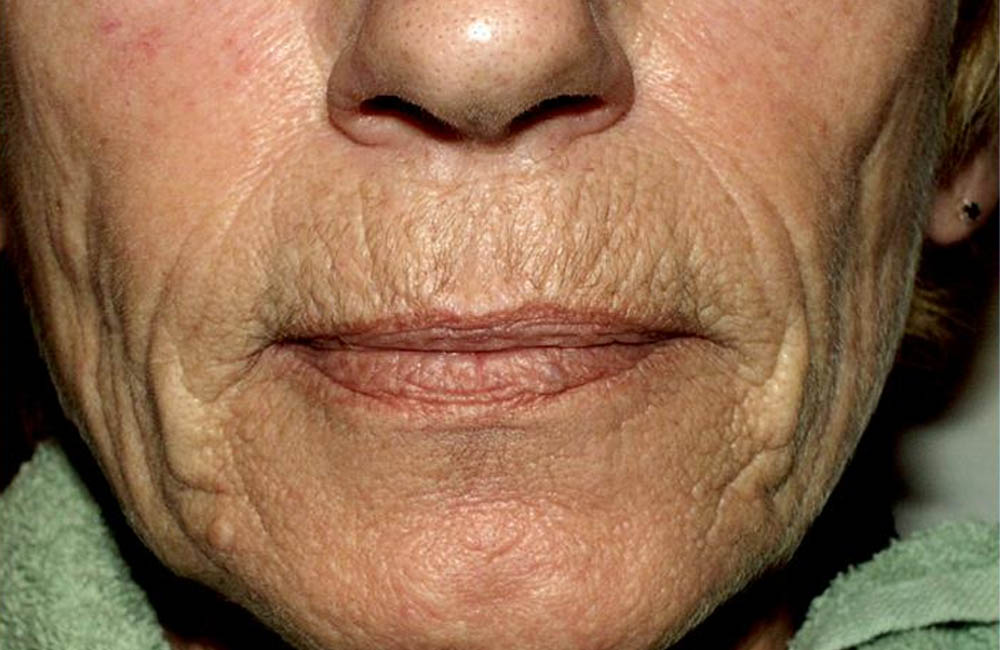 Fillers case #4366