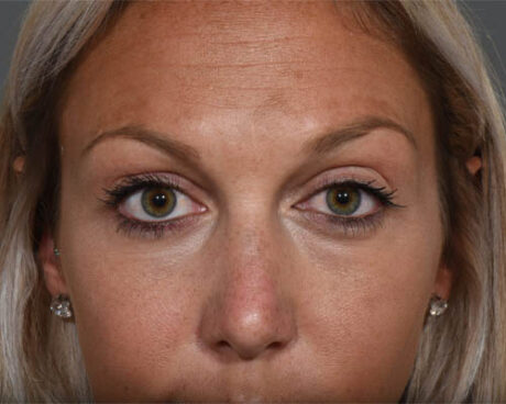 Fillers case #4357