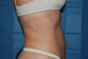 Liposuction case #4503