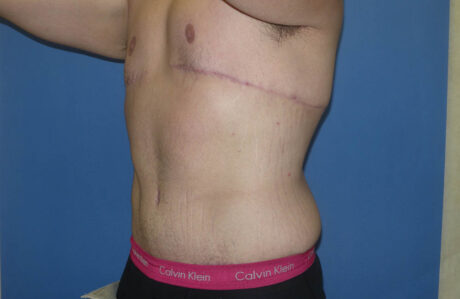 Male Breast Reduction case #4846