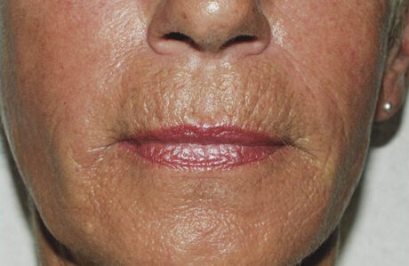 Fillers case #4366