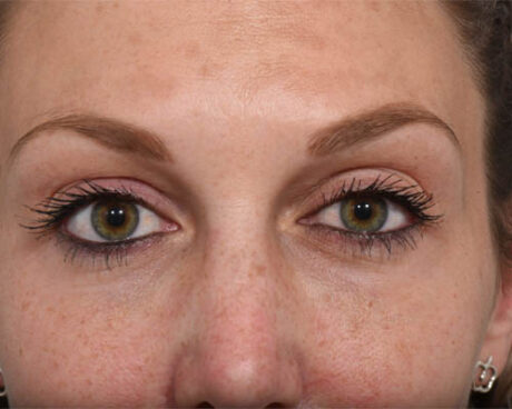 Fillers case #4357
