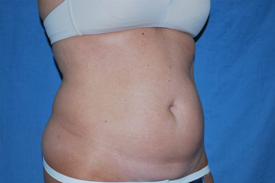 Liposuction case #4503