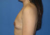 Breast Augmentation case #3879