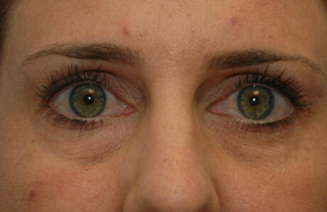 Fillers case #4363