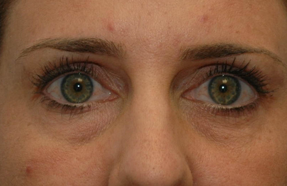 Fillers case #4363
