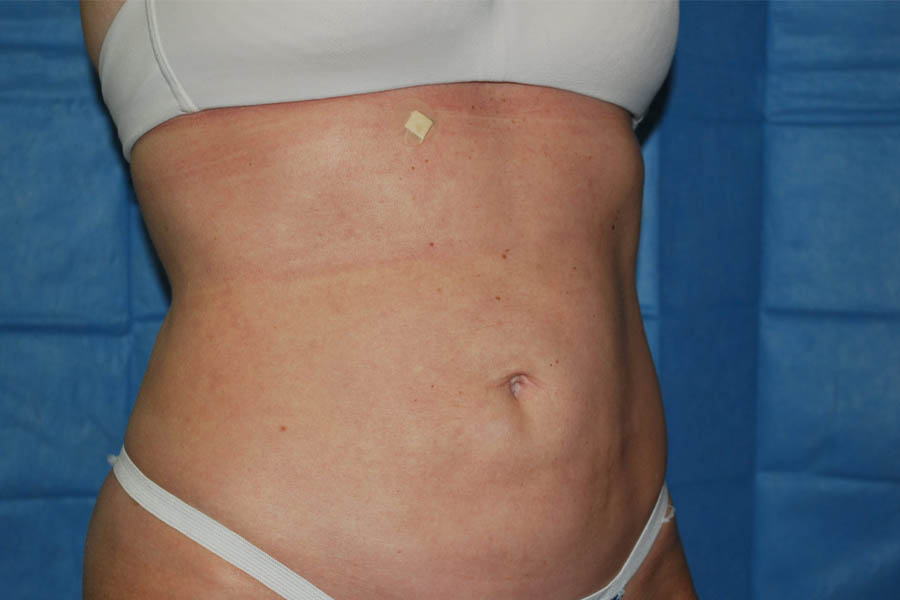 Liposuction case #4503
