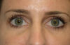 Fillers case #4363