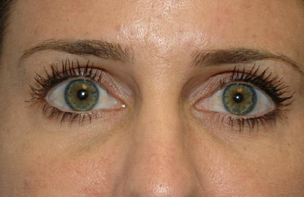 Fillers case #4363