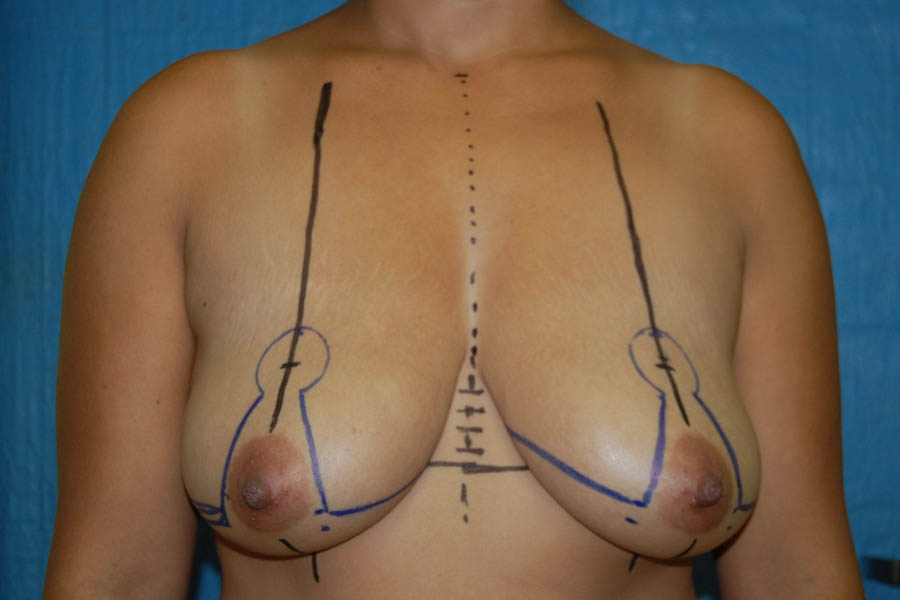 Breast Reduction case #4021
