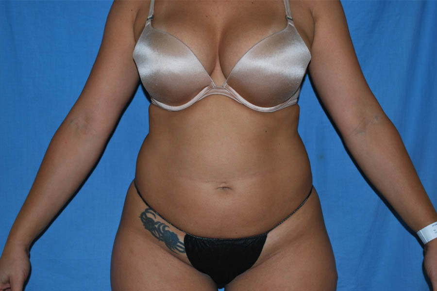 Liposuction case #4514