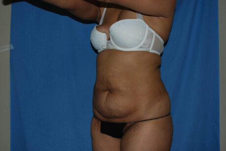 Mommy Makeover case #5638