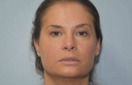 Fillers case #4360