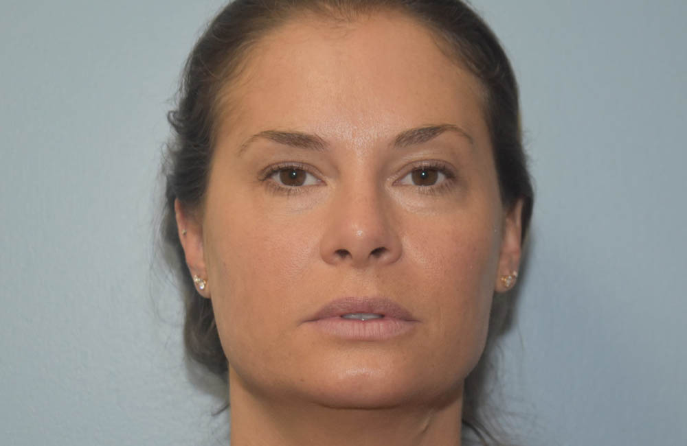 Fillers case #4360
