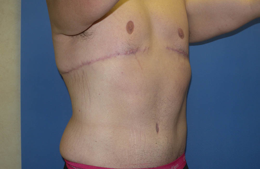 Male Breast Reduction case #4846